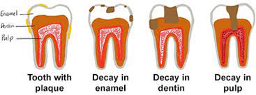 How to Prevent Cavity